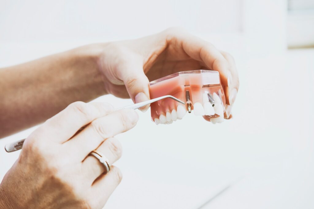 impianti dentali impianto dentale